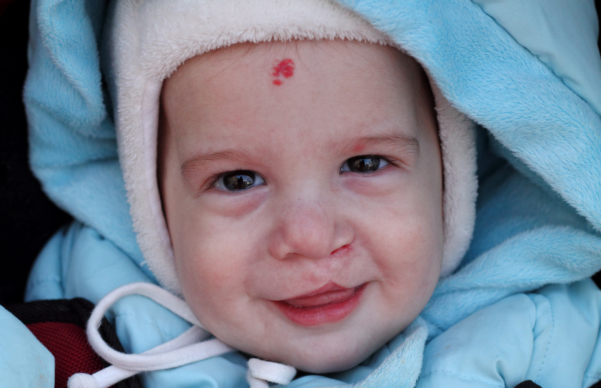 cute baby with cleft lip