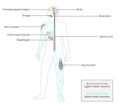 Infographic diagram of a human, pointing to body parts typically affected by ALS, including tongue, arm muscles, and diaphragm.